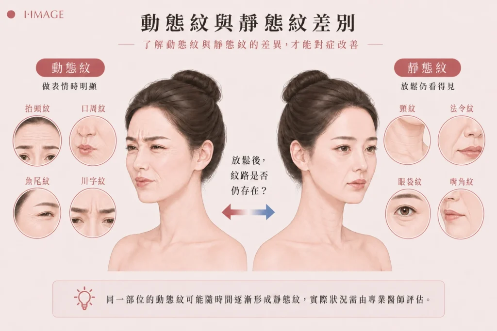 動態紋與靜態紋差別肉毒適合動態紋