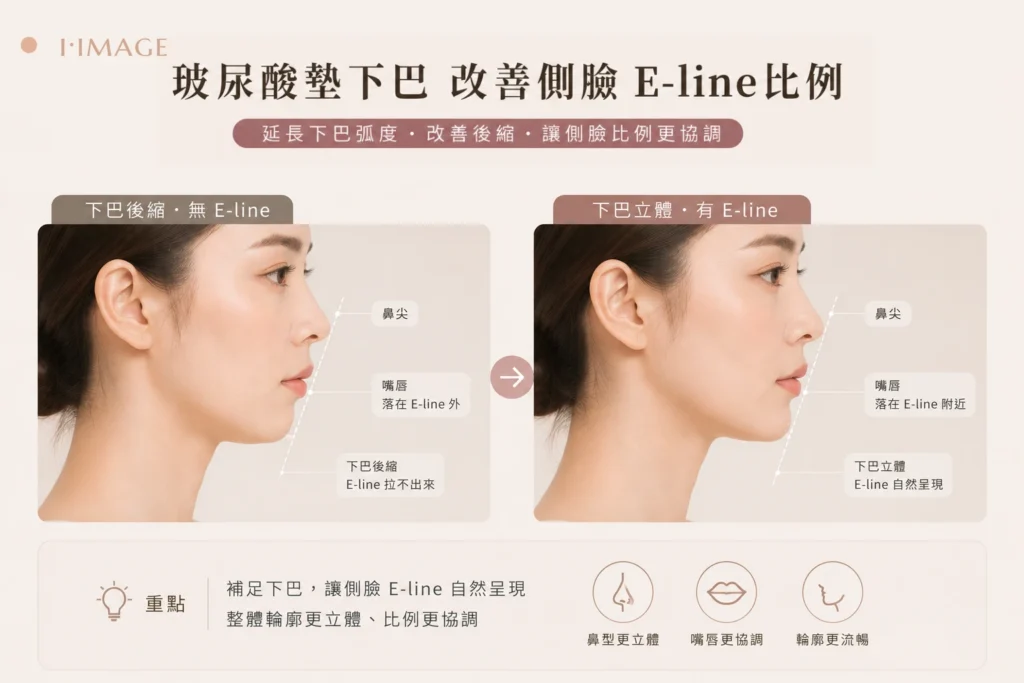 玻尿酸墊下巴改善側臉E-line比例
