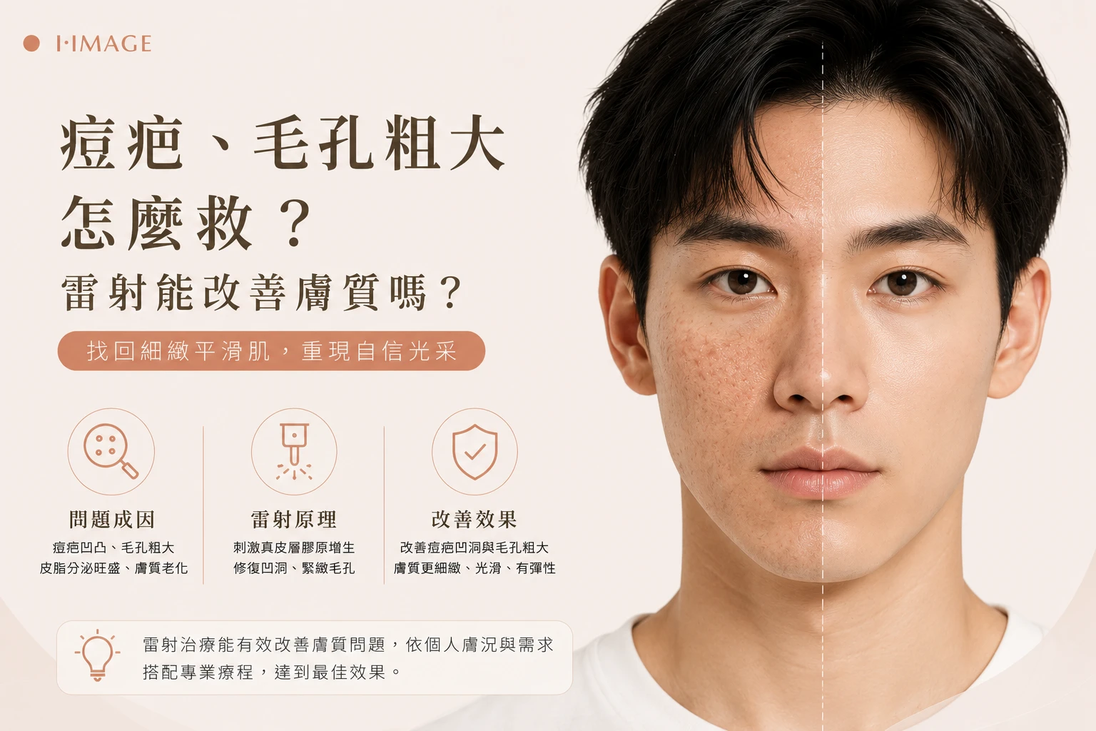 痘疤毛孔粗大雷射改善膚質-台中依美琦