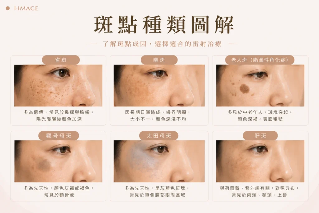斑點類型圖 :雀斑、曬斑、老人斑(脂漏性角化症)、顴骨母斑、太田母斑、肝班 示意圖