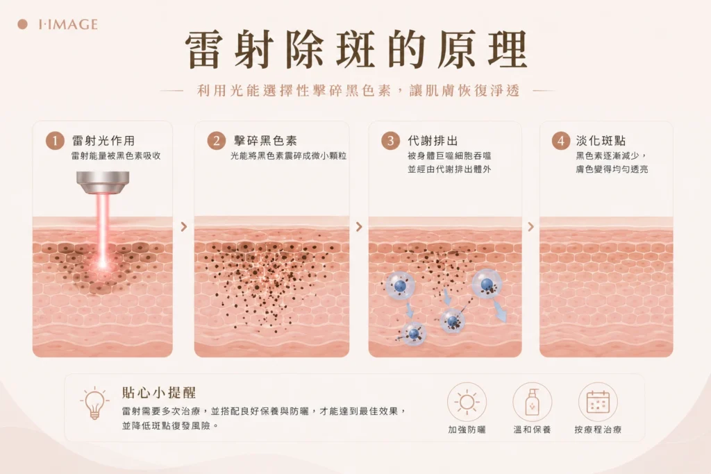 雷射除斑的原理
