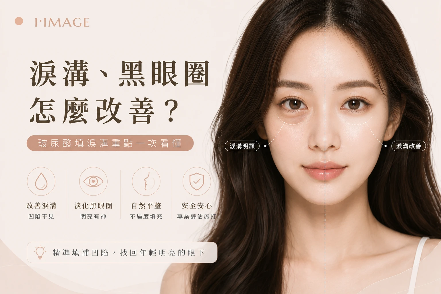 淚溝黑眼圈玻尿酸改善-台中依美琦