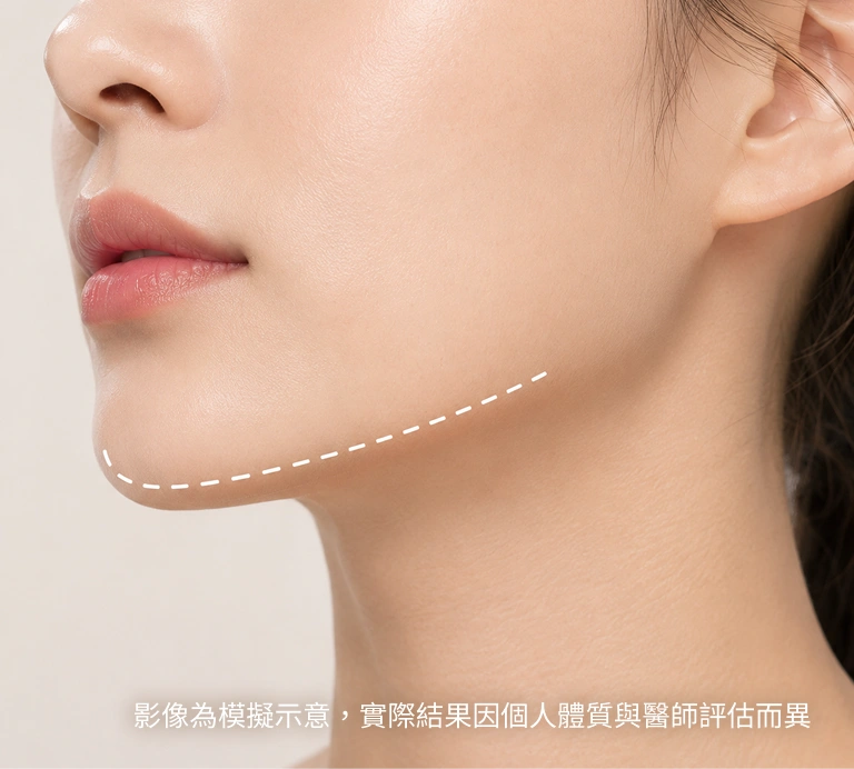 玻尿酸下巴