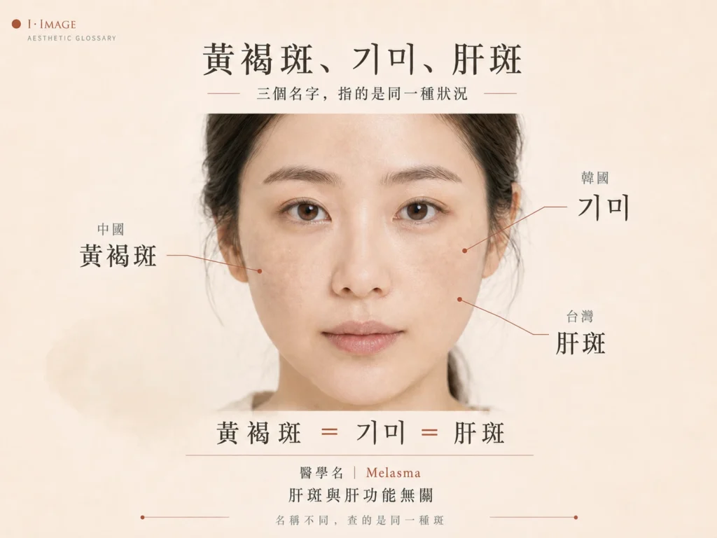 黃褐斑、韓文 기미與台灣肝斑名稱對照，女性雙頰呈現淡褐色肝斑